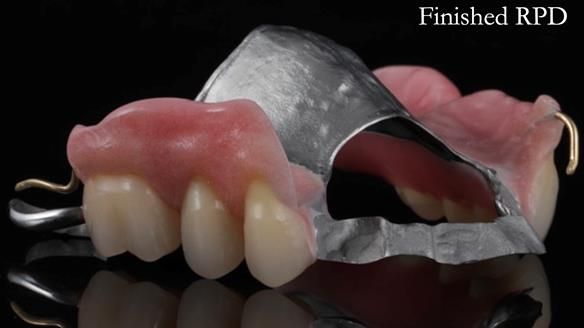 Finlay's Newsletter 60 Sylvia's upper Kennedy Class 2 Mod 1 metal based upper RPD