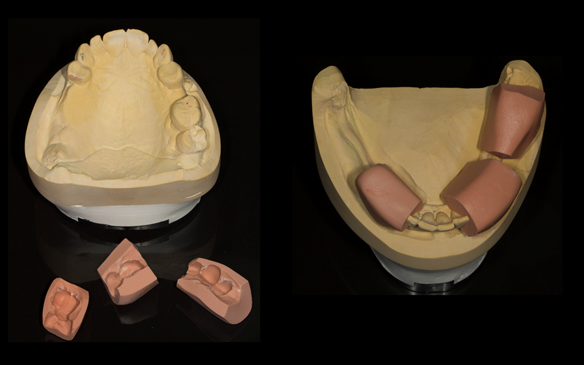 Figure 41 Mk 1 working casts with silicone matrices for temporary crowns.