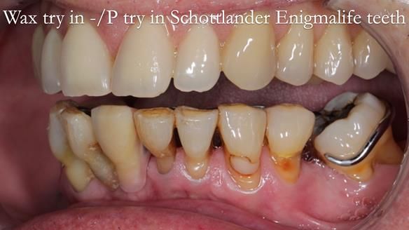 Newsletter 54 case presentation upper complete denture and lower Scandinavian designed hygienic partial denture for David