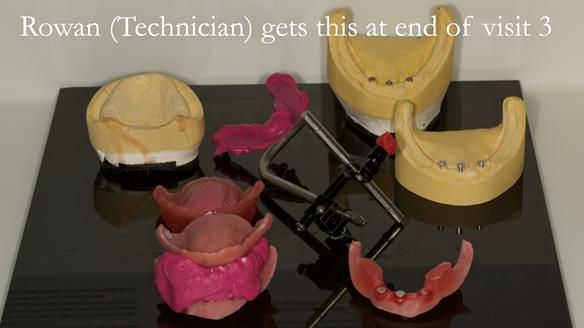 At the end of visit 3 Rowan gets back the carved upper and lower rims, the face bow transfer (used with the upper wax rim, the central bearing apparatus fixed together in CR, along with the working casts previously supplied.