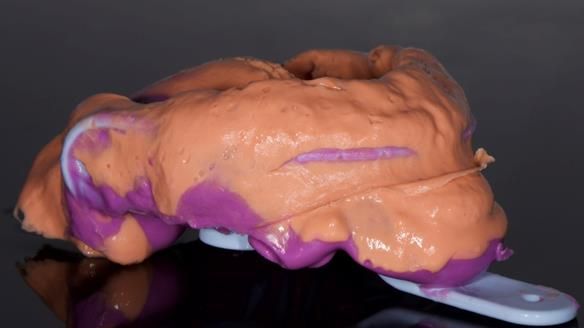 Finlay's Newsletter 64 case study - provision of a Kennedy class 2 metal based Scandinavian RPD for Ian