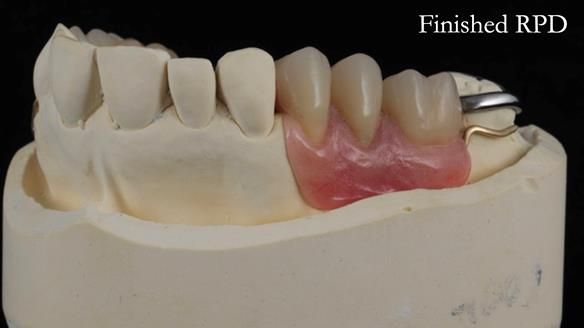 Finlay's Newsletter 60 Sylvia's upper Kennedy Class 2 Mod 1 metal based upper RPD