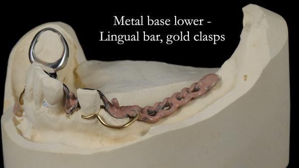 Newsletter 55 Provision of metal based partial dentures for Zephyrine with a repaired cleft lip and palate