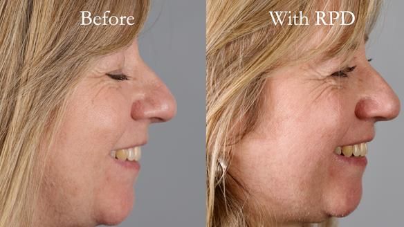 Solving Sue's failed implants with metal based RPD - full protocol Newsletter 43