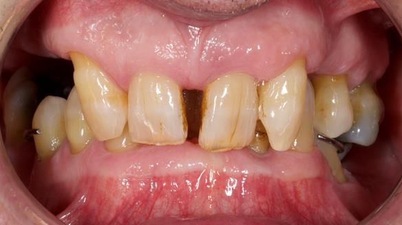 Newsletter 86 Peter the Architect — precision removable partial dentures case study