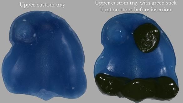 Newsletter 55 Provision of metal based partial dentures for Zephyrine with a repaired cleft lip and palate