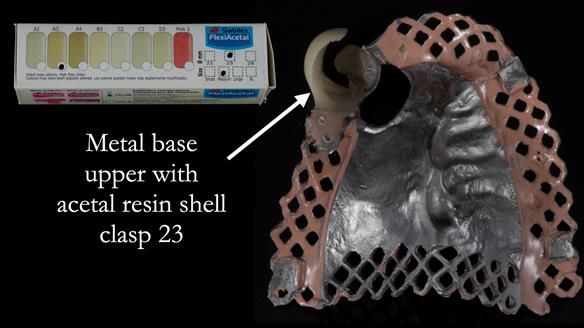 Newsletter 55 Provision of metal based partial dentures for Zephyrine with a repaired cleft lip and palate