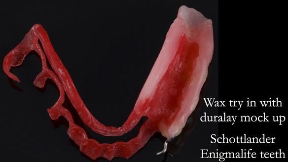 Finlay's Newsletter 61 provision of a lower unilateral free end saddle metal based partial denture for Joyce