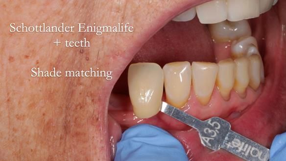 Finlay's Newsletter 61 provision of a lower unilateral free end saddle metal based partial denture for Joyce