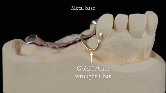 Finlay's Newsletter 60 Sylvia's upper Kennedy Class 2 Mod 1 metal based upper RPD