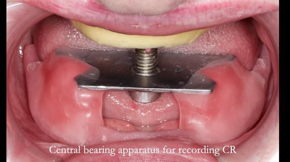Replacing Madeline’s Complete denture FULL PROTOCOL