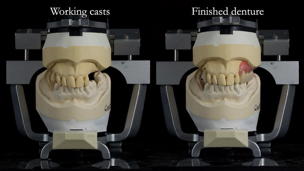 Newsletter 89 – Simon: A Challenging Kennedy Class II Division 1 Upper CoCr Partial Denture with a High Smile Line