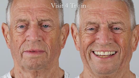 Newsletter 54 case presentation upper complete denture and lower Scandinavian designed hygienic partial denture for David