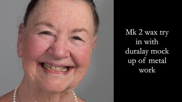 Finlay's Case Study Newsletter 40 - Immediate Mk 1 RPD to Definitive Mk 2 RPD - full protocol