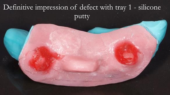 Upper metal base partial denture/occlusal stabilisation splint/obturator - full protocol