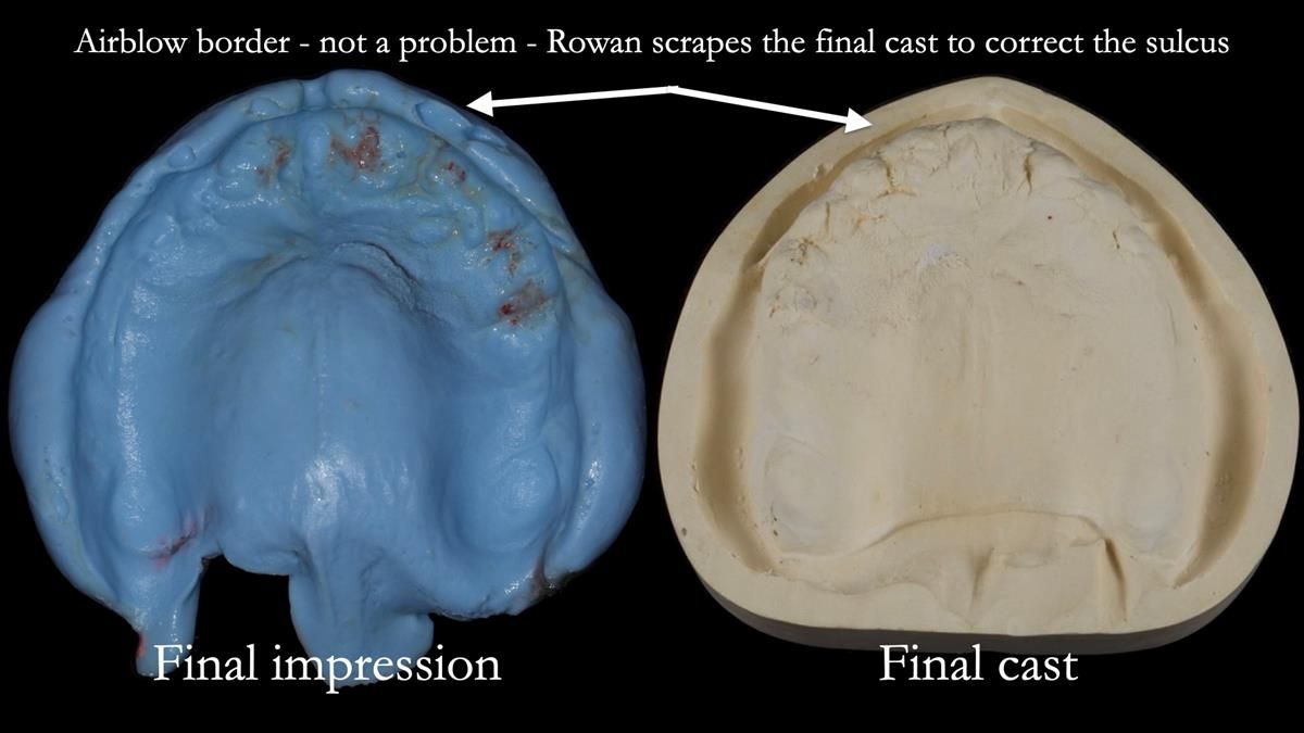 Fin’s Newsletter 88 — Complete dentures - full protocol… he rearranged his own teeth!