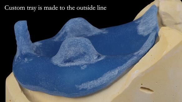 Newsletter 53 showing the making and fitting of ultra life-like dentures for Valena