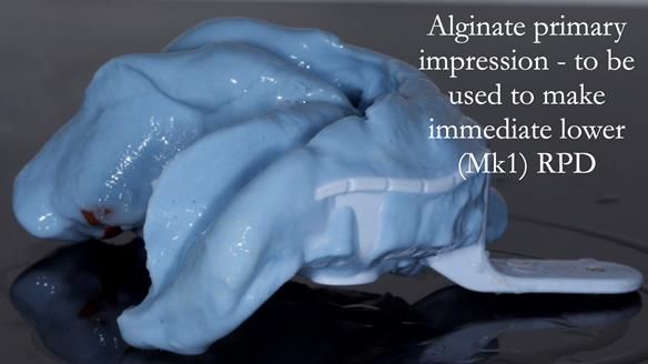 Newsletter 54 case presentation upper complete denture and lower Scandinavian designed hygienic partial denture for David