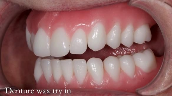 Newsletter 65 Marisa Provision of Complete Dentures on badly placed implants