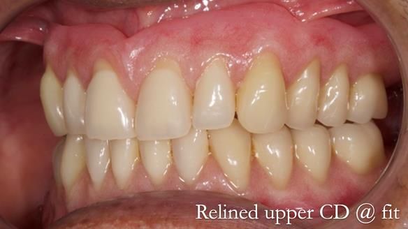 Finlay's Newsletter 62 provision of extractions and metal based complete dentures for Rafique