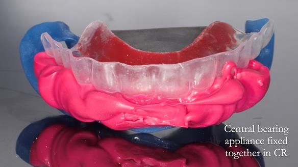 Newsletter 82 Mary - A complete upper and a one-tooth gasket denture