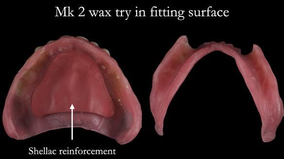 Newsletter 52 Managing Jo’s failing dentition with extractions and Mk 1/Mk 2 complete upper dentures and lower partial dentures FULL PROTOCOL