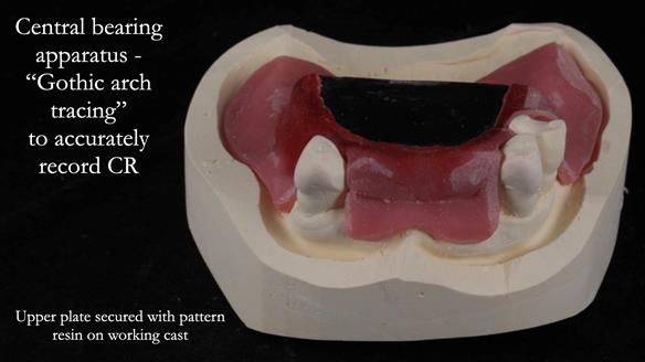 Finlay's Newsletter 59 Ultra hard partial dentures made for Gill