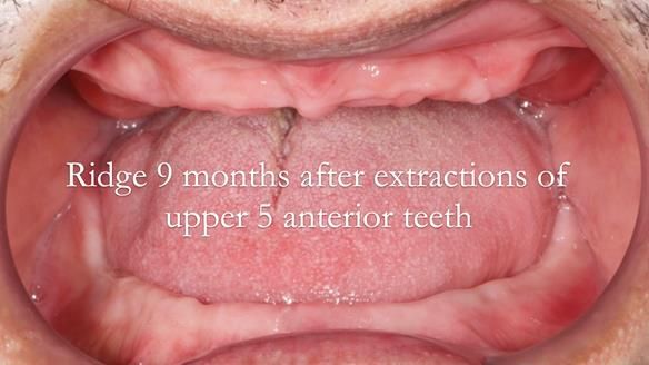 Finlay's Newsletter 62 provision of extractions and metal based complete dentures for Rafique