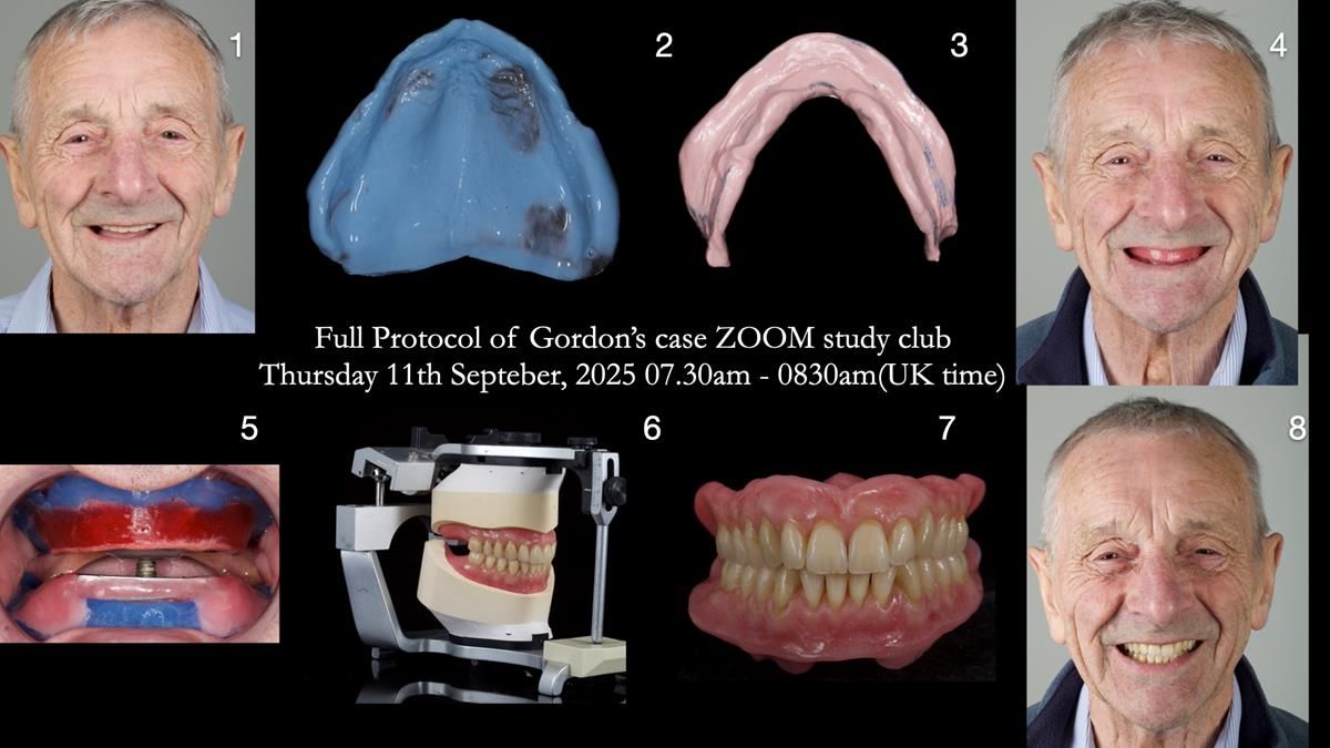 Newsletter 80 - Gordon’s dentures: the one case in 1,000 where my technique failed