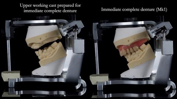 Newsletter 77: Jeremy’s case – immediate complete upper denture