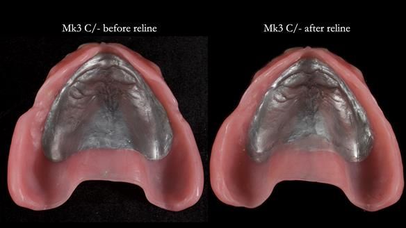 Newsletter 77: Jeremy’s case – immediate complete upper denture