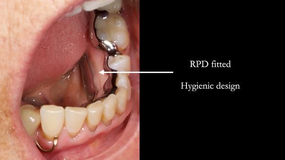 Finlay's Newsletter 61 provision of a lower unilateral free end saddle metal based partial denture for Joyce
