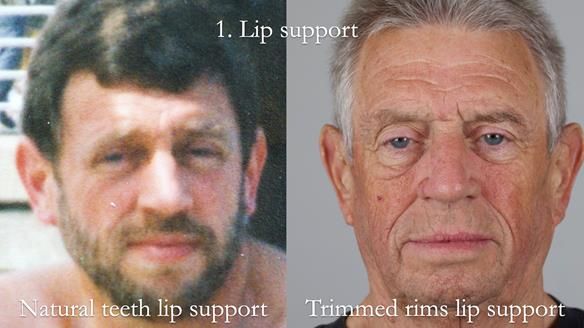 Newsletter 54 case presentation upper complete denture and lower Scandinavian designed hygienic partial denture for David