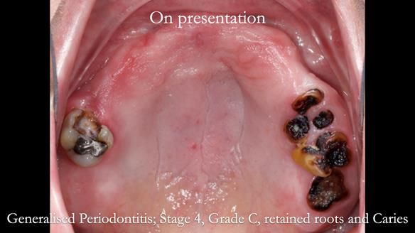 Newsletter 52 Managing Jo’s failing dentition with extractions and Mk 1/Mk 2 complete upper dentures and lower partial dentures FULL PROTOCOL