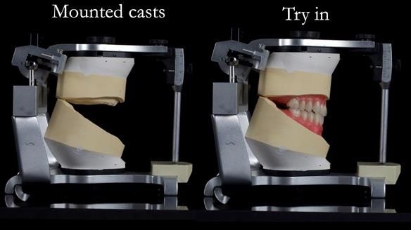 Newsletter 68 Restoring Jan’s Smile: Complete Dentures Inspired by Her Daughter’s Teeth - Post Mouth Surgery