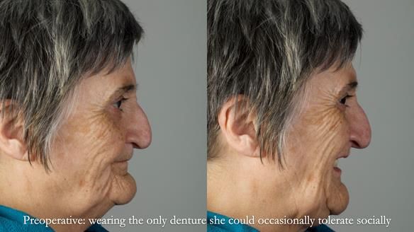 Newsletter 83: Sheila’s Complete Denture Success