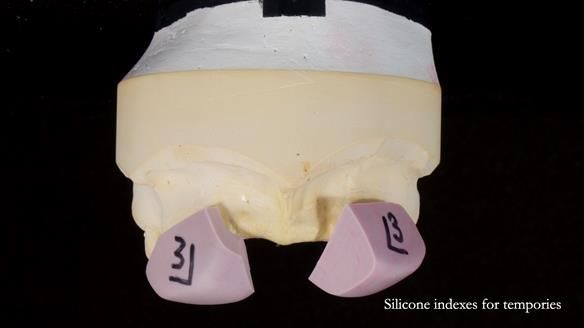 Newsletter 81 - Pam’s Story — how a partial denture changed her life (+ live walkthrough this Thursday)