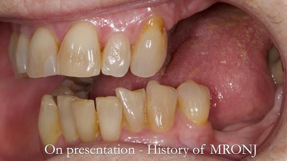 Finlay's Newsletter 60 Sylvia's upper Kennedy Class 2 Mod 1 metal based upper RPD