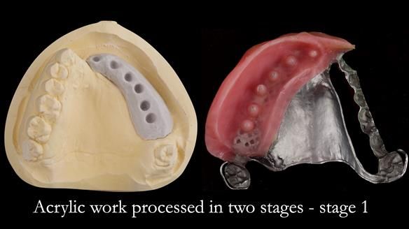 Upper metal base partial denture/occlusal stabilisation splint/obturator - full protocol