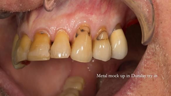 Ken – going downhill, first class