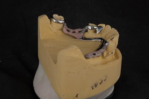 Figure 70 cobalt chromium framework - Scandinavian design with sublingual bar - keeping the denture components 3mm away from the gingival margin.