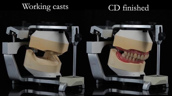 Finlay's Newsletter 62 provision of extractions and metal based complete dentures for Rafique