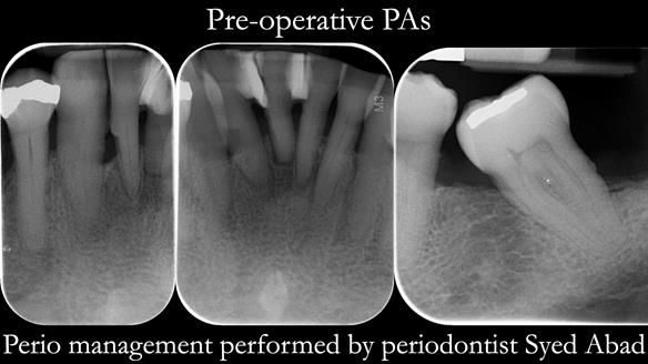 Newsletter 54 case presentation upper complete denture and lower Scandinavian designed hygienic partial denture for David