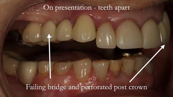Newsletter 51 Managing Anne’s failing dentition with distal extension base RPD/Splint FULL PROTOCOL