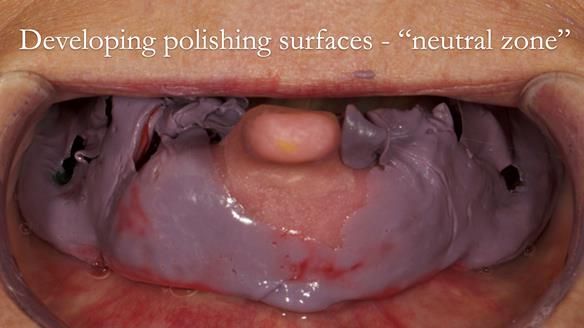 The borders are moulded by the 5 movements the patient makes.