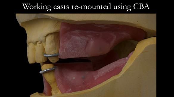 Finlay's Case Study Newsletter 40 - Immediate Mk 1 RPD to Definitive Mk 2 RPD - full protocol