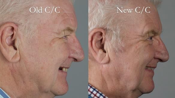 Newsletter 57 showcases the making and fitting process of implant-supported complete dentures for Alisdair