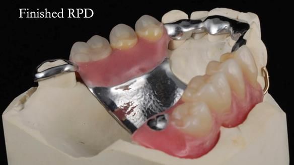 Finlay's Newsletter 60 Sylvia's upper Kennedy Class 2 Mod 1 metal based upper RPD