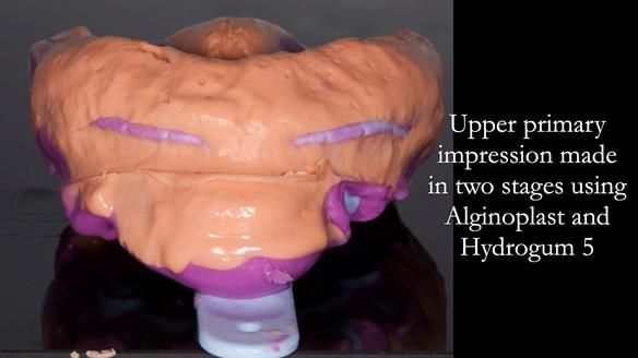 Finlay's Newsletter 64 case study - provision of a Kennedy class 2 metal based Scandinavian RPD for Ian