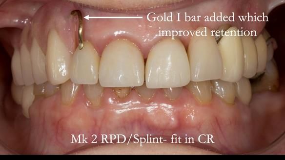 Newsletter 51 Managing Anne’s failing dentition with distal extension base RPD/Splint FULL PROTOCOL